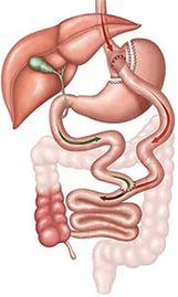 Gastric Bypass Revision, Charlotte Hodges, MD