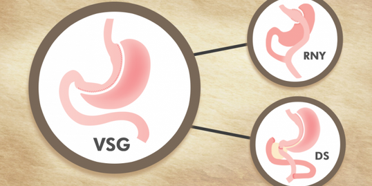 Sleeve Revision Surgery, Charlotte Hodges, MD
