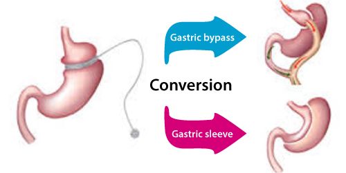 Band Revision Surgery, Charlotte Hodges, MD